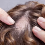 Zurück zu Ihrem Haar: Ein globaler Leitfaden zu Alopeziebehandlungen und Haarwiederherstellung