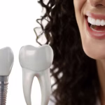 Revolutionize Your Life with Premier Full Arch Dental Implants in Guangzhou: The Gold Standard in Affordable Smile Restoration