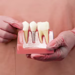 Achieve a Perfect Smile: The Ultimate 2026 Guide to Premium Full Arch Dental Implants in Guangzhou