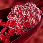 Deep Vein Thrombosis and Pulmonary Embolism