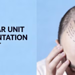 The Global Definitive Guide to Follicular Unit Transplantation (FUT): Restoring Density and Confidence