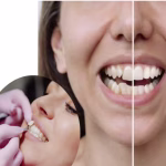 Achieve a Radiant, Hollywood Smile: The Definitive 2026 Guide to Premium Dental Veneers in Guangzhou
