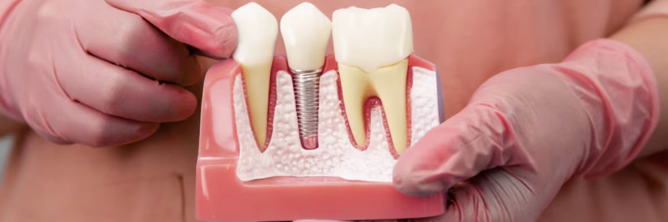 Full Mouth Dental Rehabilitation