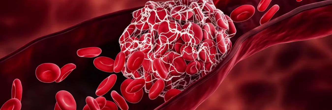 DVT Prevention Long Flights
