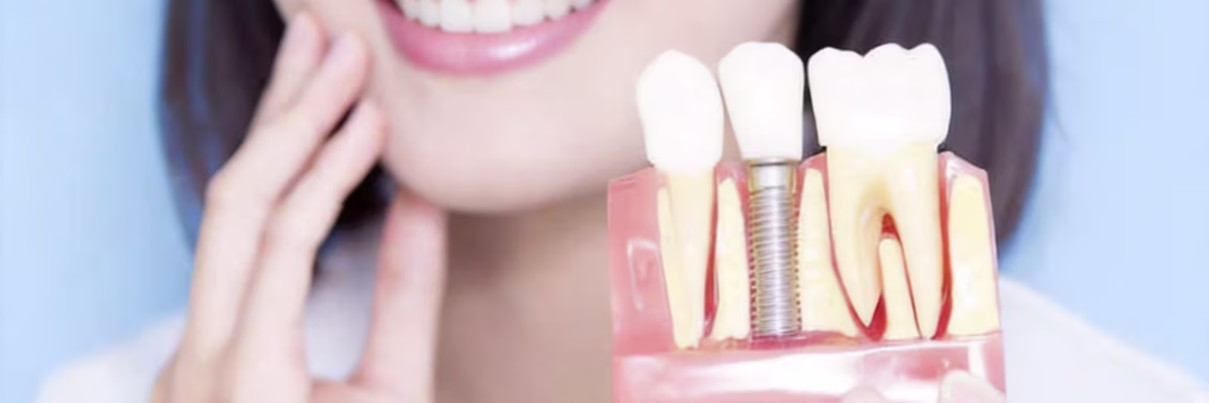 Full Mouth Dental Implants China