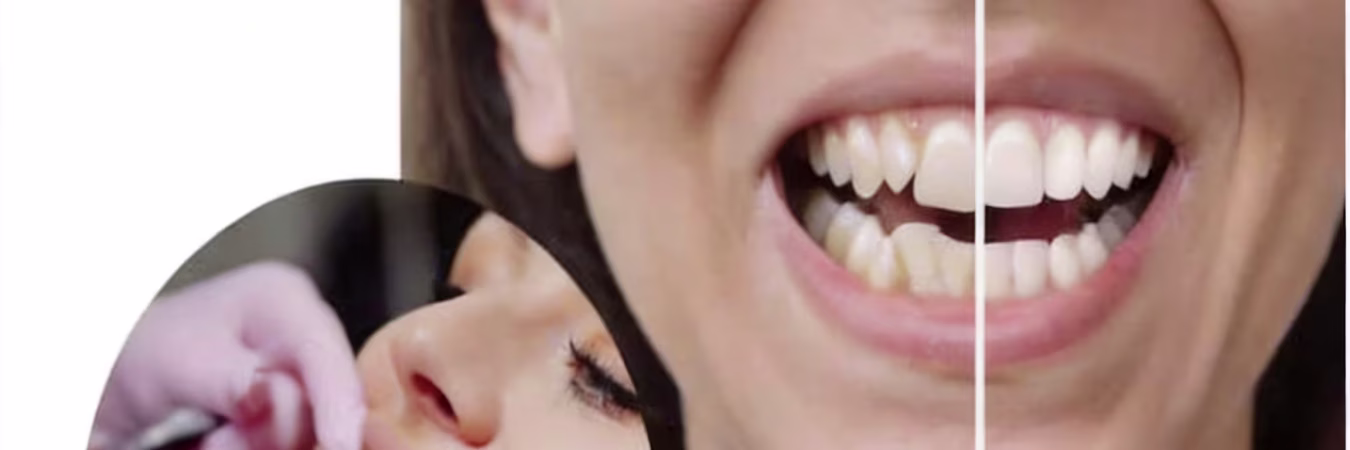 Premium Dental Veneers China