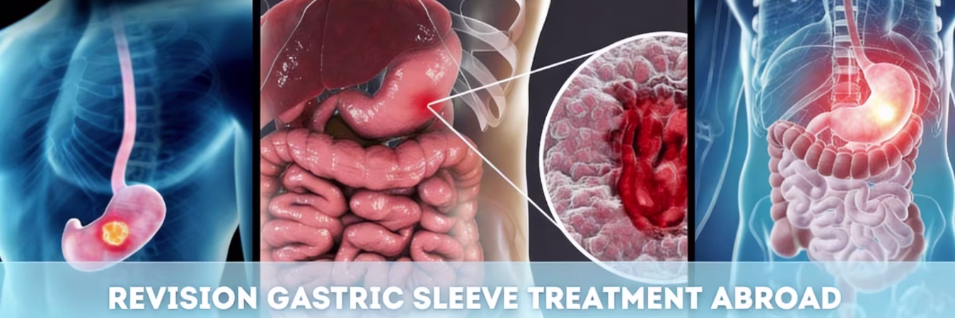 Sleeve Gastrectomy China